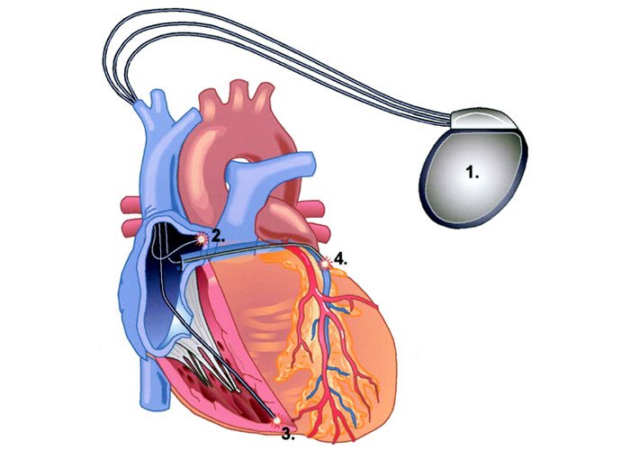 Cardiac Re-Synchronisation <br> Therapy (CRT)