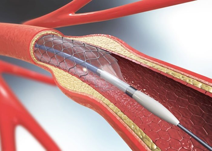 Coronary Angioplasty