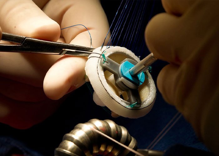Heart Valve Repair & Replacement Surgery 