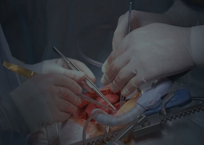 Open Heart Surgery