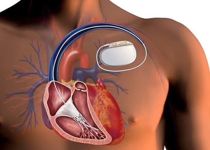 Automated Implantable Defibrillators (AICD)