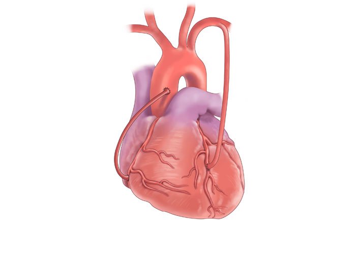 Coronary Artery Bypass Graft Surgery (CABG)