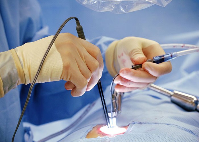 Minimally Invasive Cardiac Surgery (MICS)